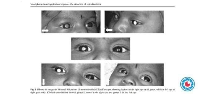 Retinoblastoma MD EyeCare