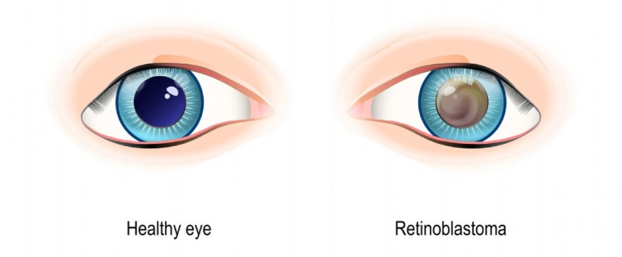 Retinoblastoma MD EyeCare